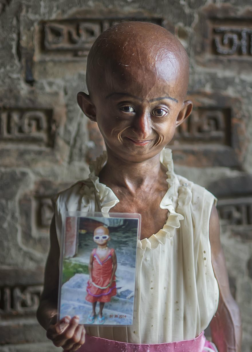 男童患早衰症父母花光积蓄四处求医