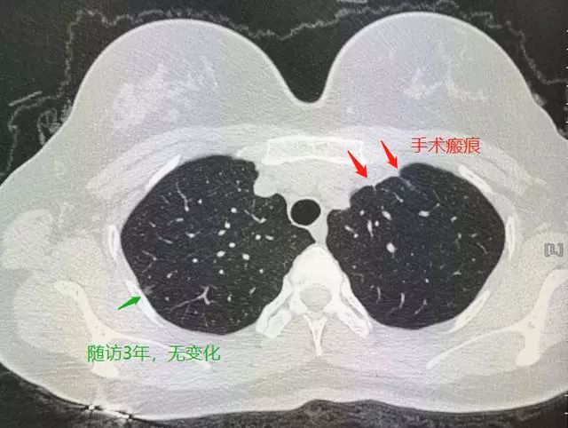 震惊！27岁女子忽视肺结节1年后竟确诊肺癌！这些早期信号千万别忽略