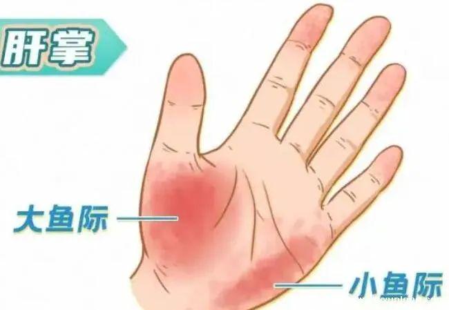 震惊！看手就能知道肝好不好！医生不会告诉你的5个秘密